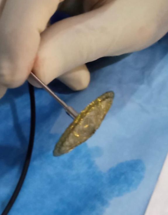 Cierre de cardiopatías congénitas