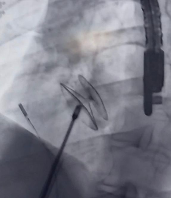 Cierre de cardiopatías congénitas