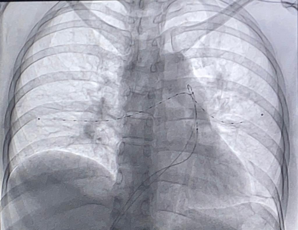 Fragmentación de trombo y trombo aspiración pulmonar