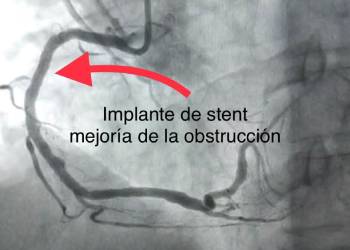 implante de stent