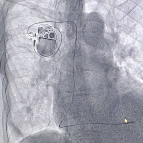 implante de marcapaso definitivo