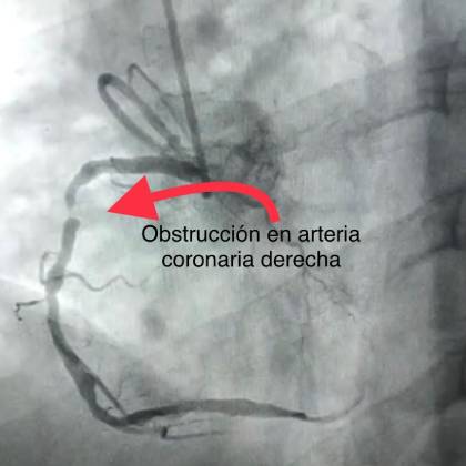 obstruccion de arteria coronaria